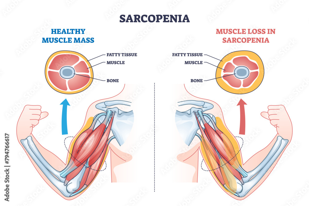Naklejka premium Sarcopenia as muscle mass loss and fatty tissue growth outline diagram, transparent background. Labeled educational medical scheme with aging caused weakness and muscular pathology illustration.