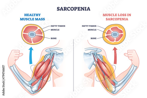 Sarcopenia as muscle mass loss and fatty tissue growth outline diagram, transparent background. Labeled educational medical scheme with aging caused weakness and muscular pathology illustration. photo