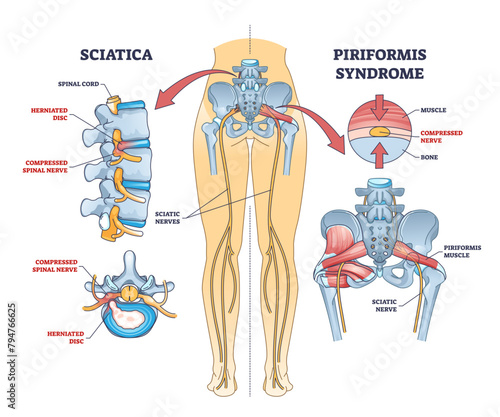 Sciatica vs piriformis medical muscle conditions comparison outline diagram, transparent background. Labeled educational scheme with hip anatomy and compressed nerve.