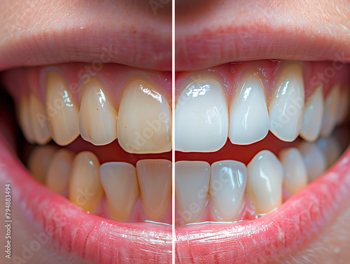 A close-up comparison of teeth before and after whitening treatment, showcasing the dramatic results and enhanced smile aesthetics