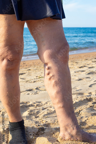 Vertical photo of Sick female legs with thrombophlebitis and bumps, against the backdrop of the sea
