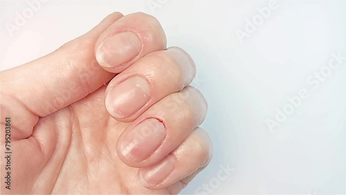A woman shows a cuticle cut with bleeding. Injuries in the process of unprofessional traumatic manicure and cuticle cutting photo