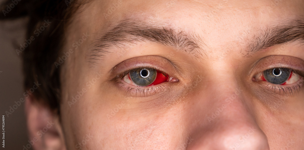 Naklejka premium Bloodshot Eye with Red Veins. Broken Blood Vessels. Sore, Inflamed Eyeballs Close up.
