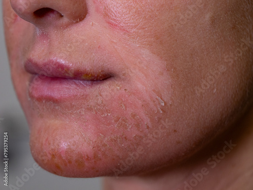 CLOSE UP, DOF: Lady with a damaged epidermis and reddened flaky facial skin. Peeled skin on face of a young woman with signs of severe inflammation and allergic reaction to dangerous sun exposure. © helivideo