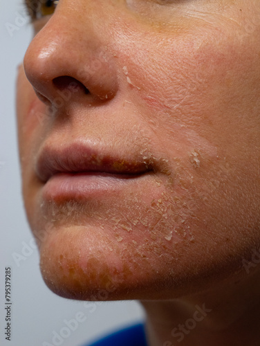 CLOSE UP, PORTRAIT: Unhealthy reddened and flaky skin on the face of young woman. Lady with a damaged epidermis on her face suffers from itchy and irritated red skin caused by extreme sun exposure.
