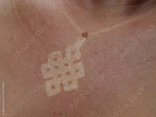 CLOSE UP, DOF: Unhealthy red burnt skin with visible white necklace pendant mark. Young lady was overdoing her tanning under the strong summer sun and suffered severe and harmful burns on her skin.