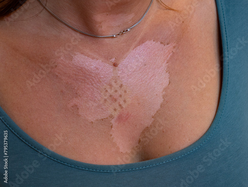 CLOSE UP, DOF: Woman with a reddish and peeling skin after dangerous sunburn. Unhealthy red burnt skin with visible white necklace pendant mark after careless and excessive exposure to summer sun. © helivideo