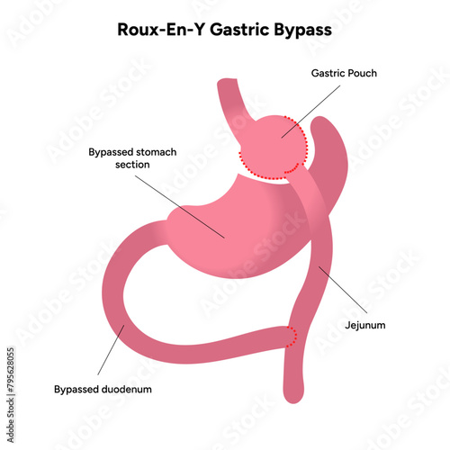 Roux-en-y gastric bypass