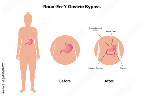 Roux-en-y gastric bypass
