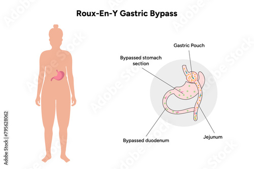 Roux-en-y gastric bypass, medical infographic 