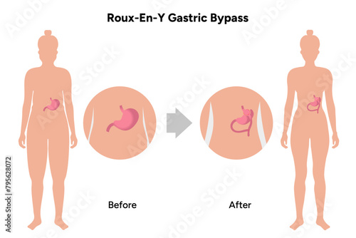Roux-en-y gastric bypass
