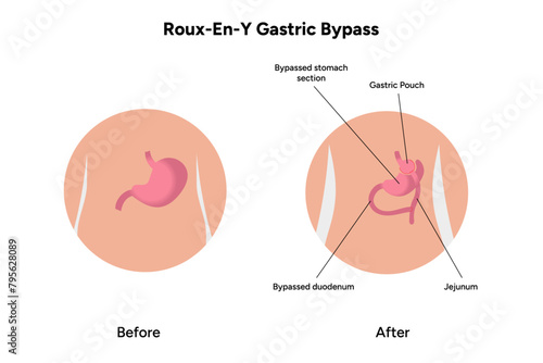 Roux-en-y gastric bypass