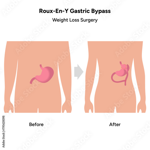 Roux-en-y gastric bypass, weight loss surgery photo