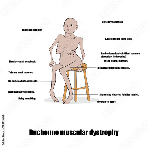 Duchenne muscular dystrophy, an inherited disorder characterized by progressive muscle weakness.