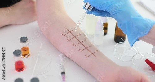 Allergy test skin prick test for possible allergens photo