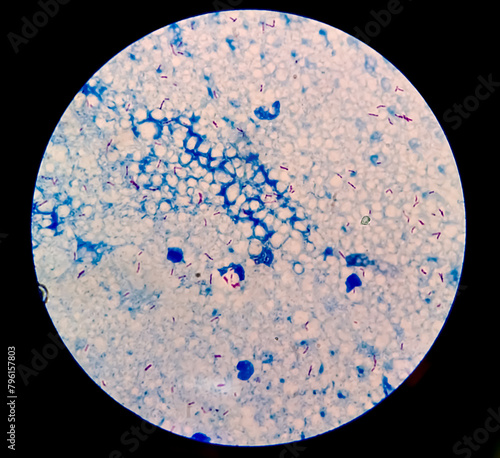 Microscopic 100x image of AFB stainig. Microbacterium Tuberculosis Bacteria (MTB). Sputum or phlegm smear, increase contrast. photo