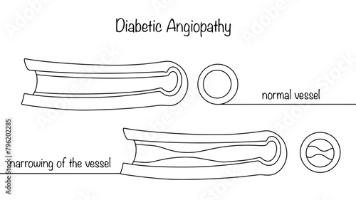 Diabetic angiopathy