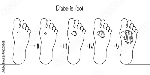 Stages of diabetic foot photo