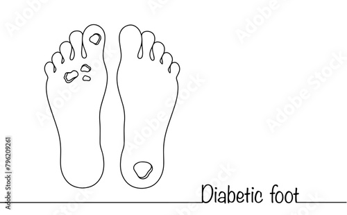 Diabetic foot