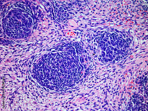Microscopic Image of a Wilms Tumor or Nephroblastoma of a Childs Kidney Viewed at 200x Magnification with Hematoxylin and Eosin Staining.One of the most Common Cancers Affecting Children. photo