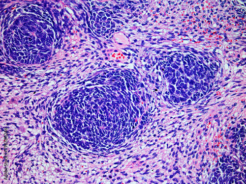 Microscopic Image of a Wilms Tumor or Nephroblastoma of a Childs Kidney Viewed at 200x Magnification with Hematoxylin and Eosin Staining.One of the most Common Cancers Affecting Children.