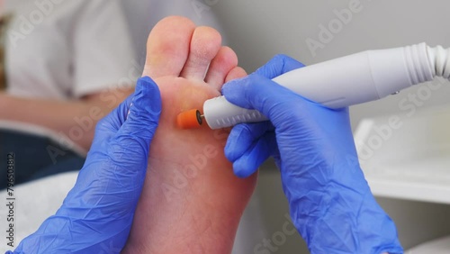 A professional podologist cleanses the skin from calluses on the sole of a female client with a special electric burr twister tool. Foot care photo