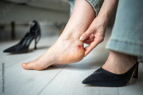 Callus blister on heel from tight shoes. Woman feet in pain after wearing high heeled shoes after walking. Female touching her ankle with sore. Corns  blisters on foot. Uncomfortable shoes problems.