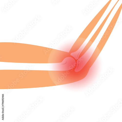 Pain in the elbow. Illustration of the elbow in section. bones of the hands. The concept of elbow injury.