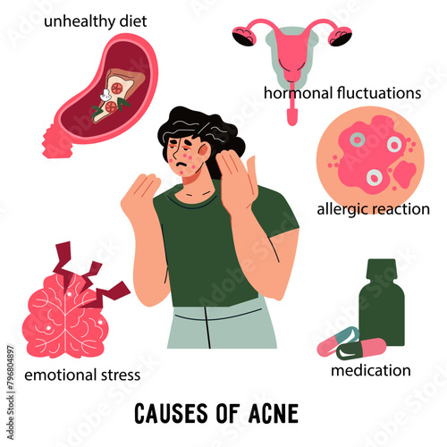Poster about the causes of acne and how to care for skin through dermatology. Skin problem causes infographic, flat vector illustration on white background.