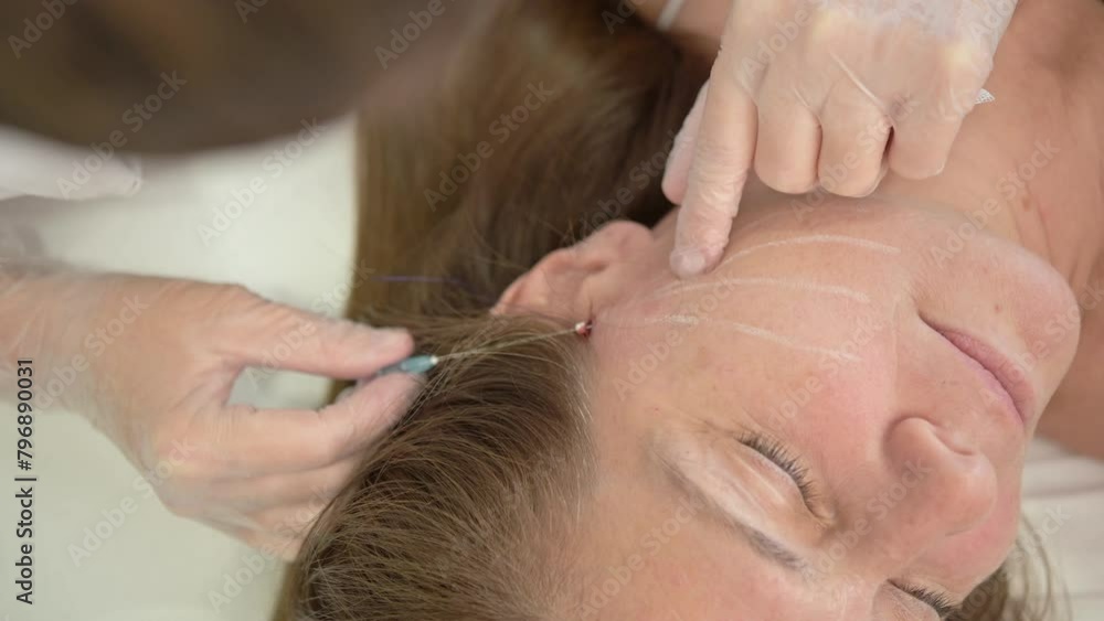 A thread facelift as an alternative to traditional facelift surgery A thread facelift as an alternative to traditional facelift surgery