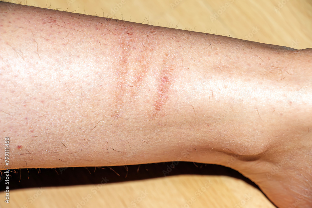 Jellyfish bite marks on a woman's leg. An allergic reaction on the skin
