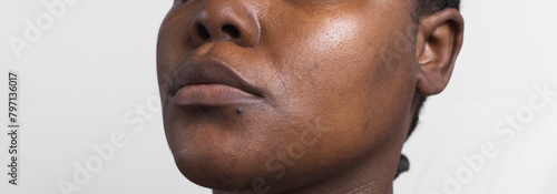 dull brown skin with dark spots, hyperpigmentation on brown skin, african american woman with skin blemishes and texture