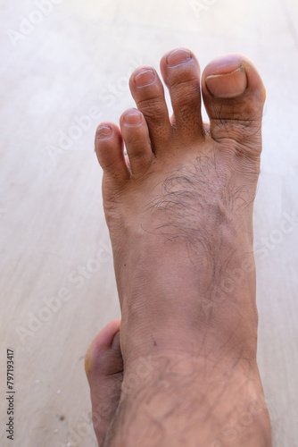 Male foot with the fourth toe shorter than usual. Mortons toe, Greek foot or royal toe or aboriginal foot. photo