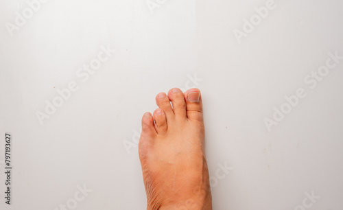 close up of a foot of a man with brachymetatarsia or Morton's foot, a condition in which there is abnormal shortening of one or more metatarsals on a white background,  photo