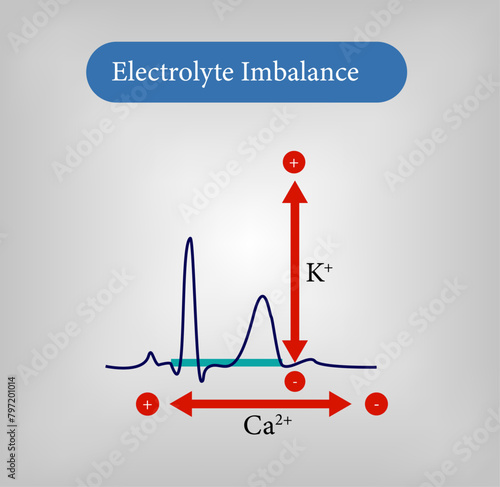 Electrolyte imbalance, ECG changes due to electrolyte imbalance Vector Illustration