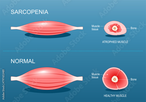 Sarcopenia. Age-related muscle atrophy.