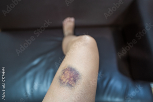 Bruises on women's legs, accident.