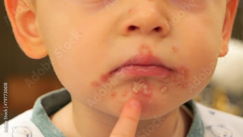 Male Toddler Scratching Itchy Impetigo Around His Lips. Bacterial Skin Infection. closeup