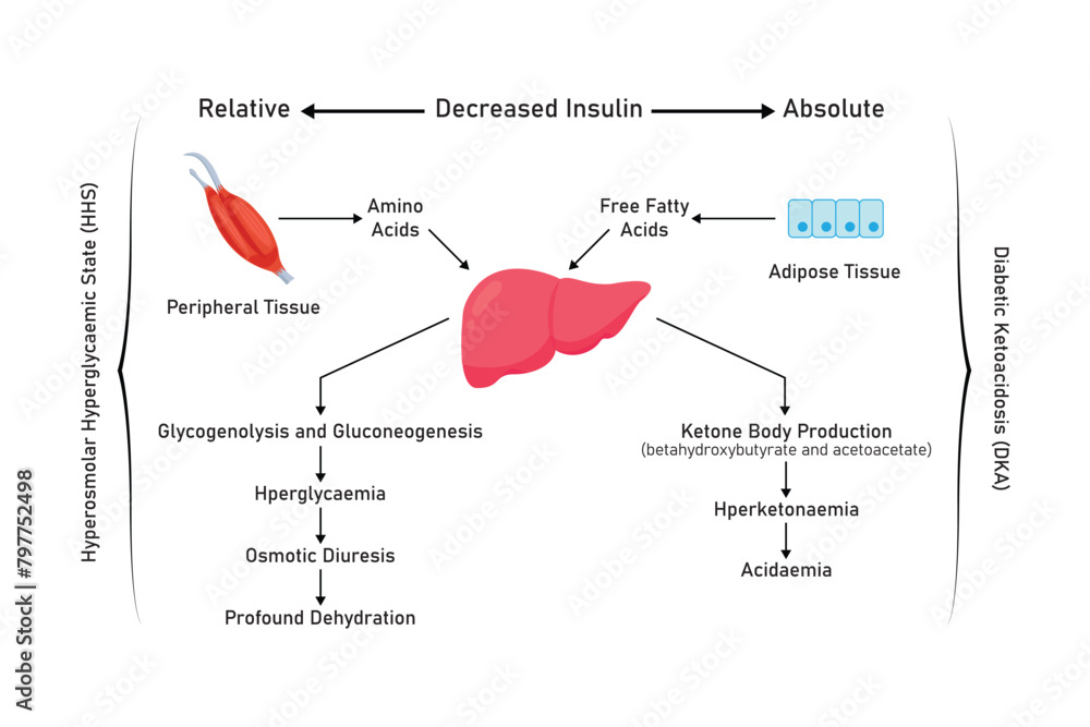 HYPEROSMOLAR HYPERGLYCEMIC STATE VS DKA visual data 8
