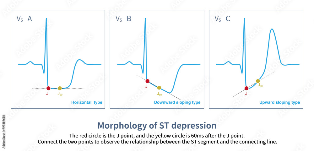 When the ST segment is depressed, the amplitude of depression at point ...