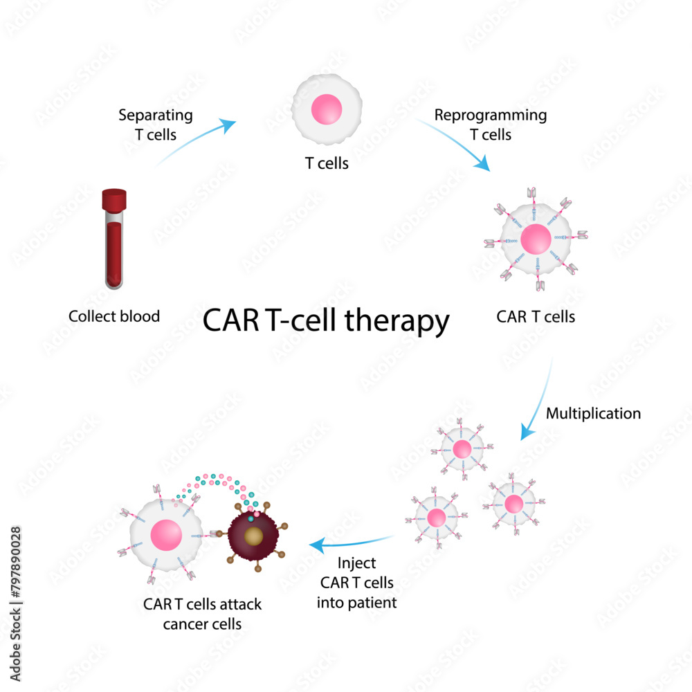 CAR T-cell therapy. Chimeric antigen receptor T cell ,CAR T cell, for ...