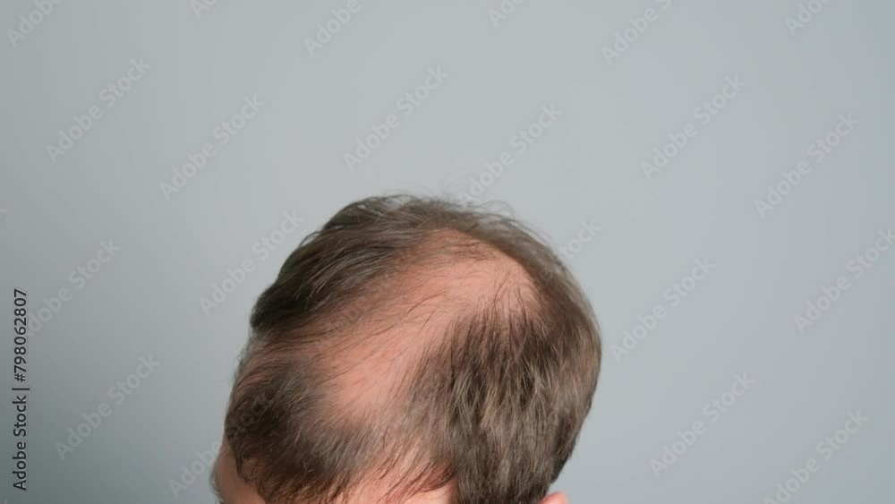 Close-up of a balding young man's head on a gray background. Close-up of a balding young man's head on a gray background.