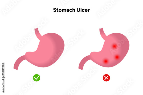 Stomach Ulcer