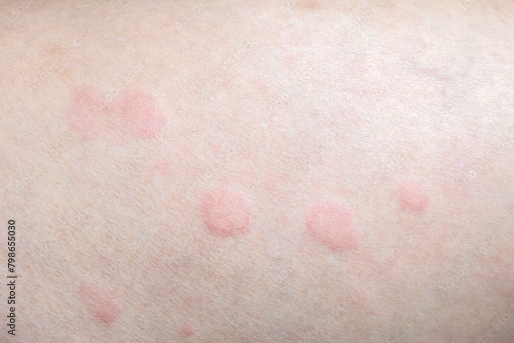Fototapeta premium Skin allergy rash dermatitis texture close up