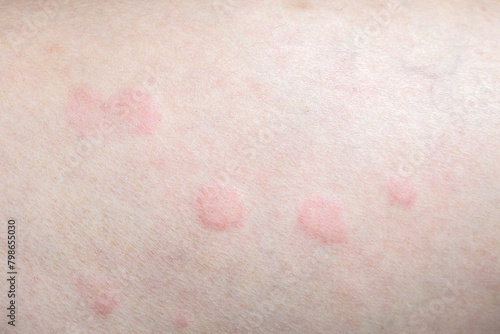 Skin allergy rash dermatitis texture close up