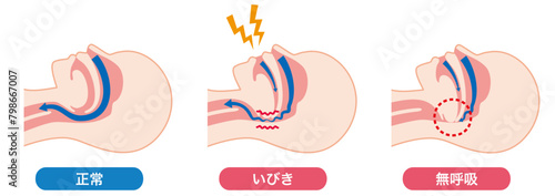 いびきと睡眠時無呼吸症候群