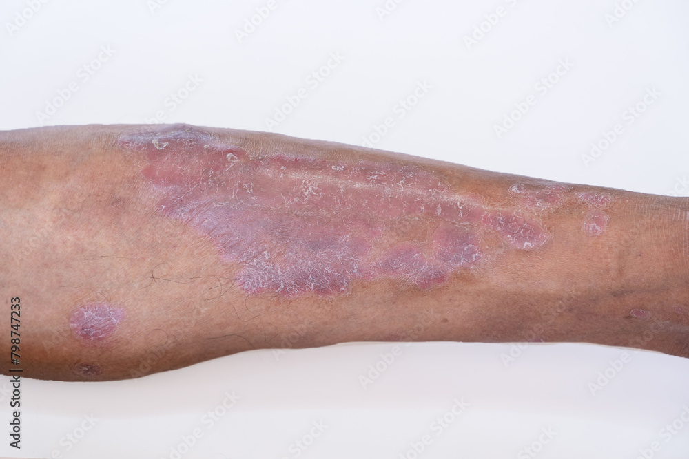 Fototapeta premium Skin disease psoriasis