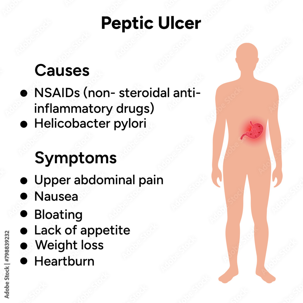 Stomach Ulcer symptoms, peptic ulcer Stomach Ulcer symptoms, peptic ulcer