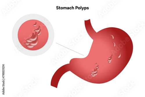 Stomach polyps. gastroenterology problem disease medical infographic 