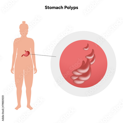 Stomach polyps. gastroenterology problem disease medical infographic 